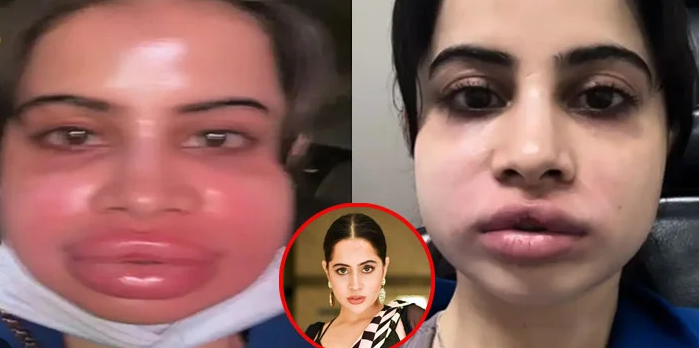 চেহারা নিয়ে ভাইরাল উরফি, মুখ-ঠোঁট ফুলে ঢোল—উদ্বিগ্ন নেটদুনিয়া